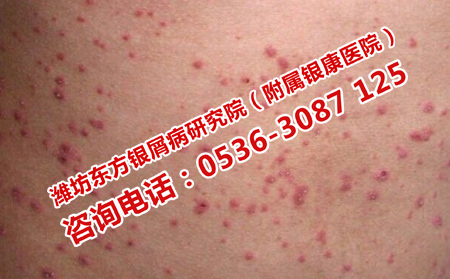 治療牛皮癬實力強的醫(yī)院