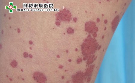 什么是過(guò)敏性紫癜癥狀有哪些?嚴(yán)重嗎?